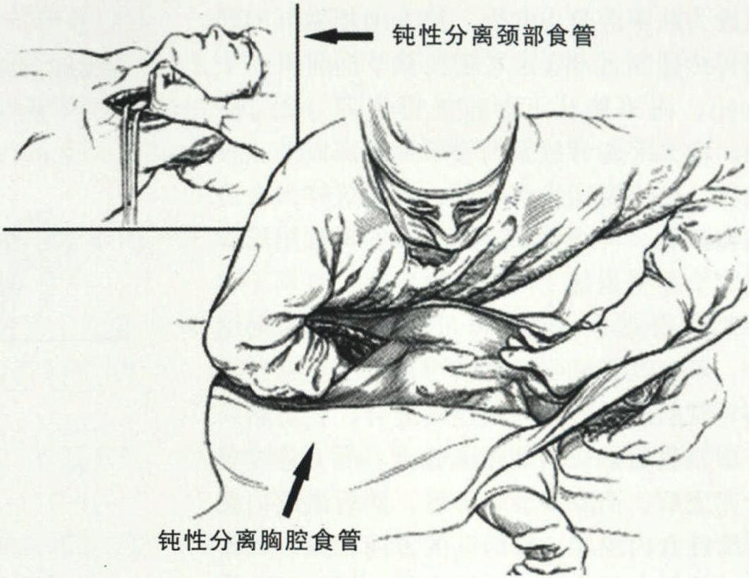 經(jīng)食管裂孔食管切除術(shù)與食管剝脫術(shù)